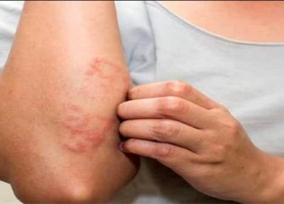 خارش و آلرژی شدید؛ ارمغان مصرف 9 ماده غذایی