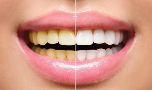 با این روش خانگی و ساده سفیدترین دندان ها را داشته باشید